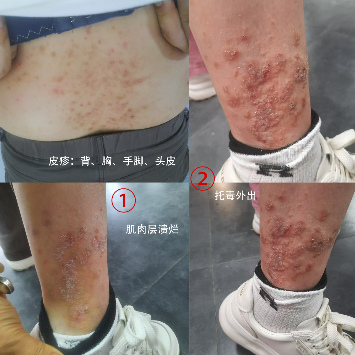 新冠疫苗解毒案例
