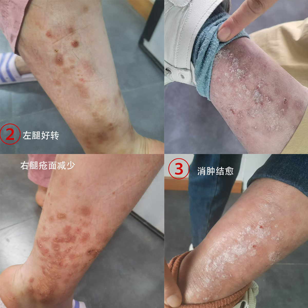 新冠疫苗解毒案例